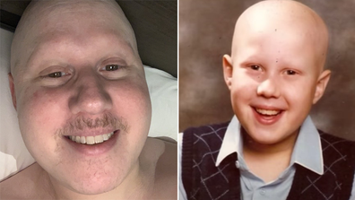 Little Britain star Matt Lucas opens up about battle with alopecia.