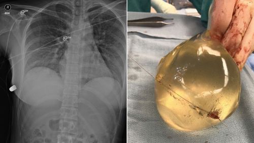 Doctors believe the woman's life was saved because of her implants, which affected the trajectory of the bullet.