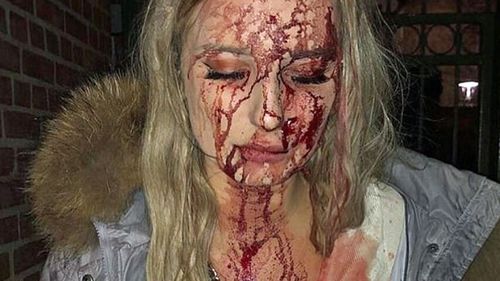 She left the club covered in blood after an unknown man allegedly struck her in the left side of the face with a glass. (Aftonbladet)