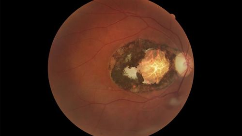 One in 150 Australians have retinal scars caused by the Toxoplasma parasite.