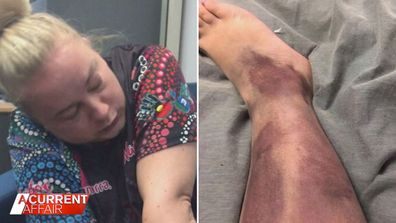 Video obtained of Jaimie Winder (left) from her colleagues in Mt Isa and a photo of her leg (right).