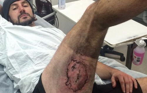 Sydney cyclist has skin graft surgery after phone explodes