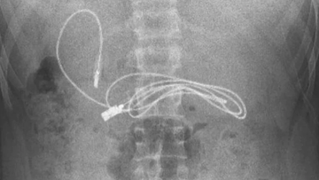 A charging cord measuring almost a metre was found inside a teen boy from Turkey.