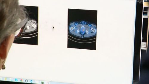 A scan of a patient is examined at Sydney's St Vincent's Hospital.