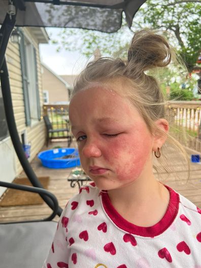 Mum warns against deadly 'poison hemlock' plant after daughter's horrible reaction.