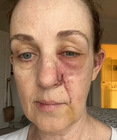 Tracy South Australia skin cancer