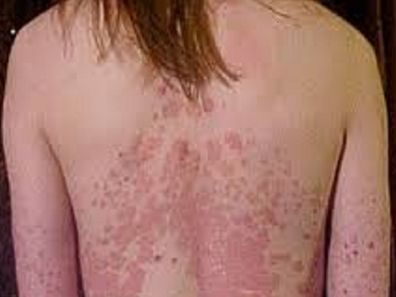 Woman with chronic psoriasis on her torso