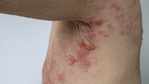 Shingles is a viral infection that causes a painful, blistering rash.It is caused by the same virus as chickenpox, called the varicella zoster virus.