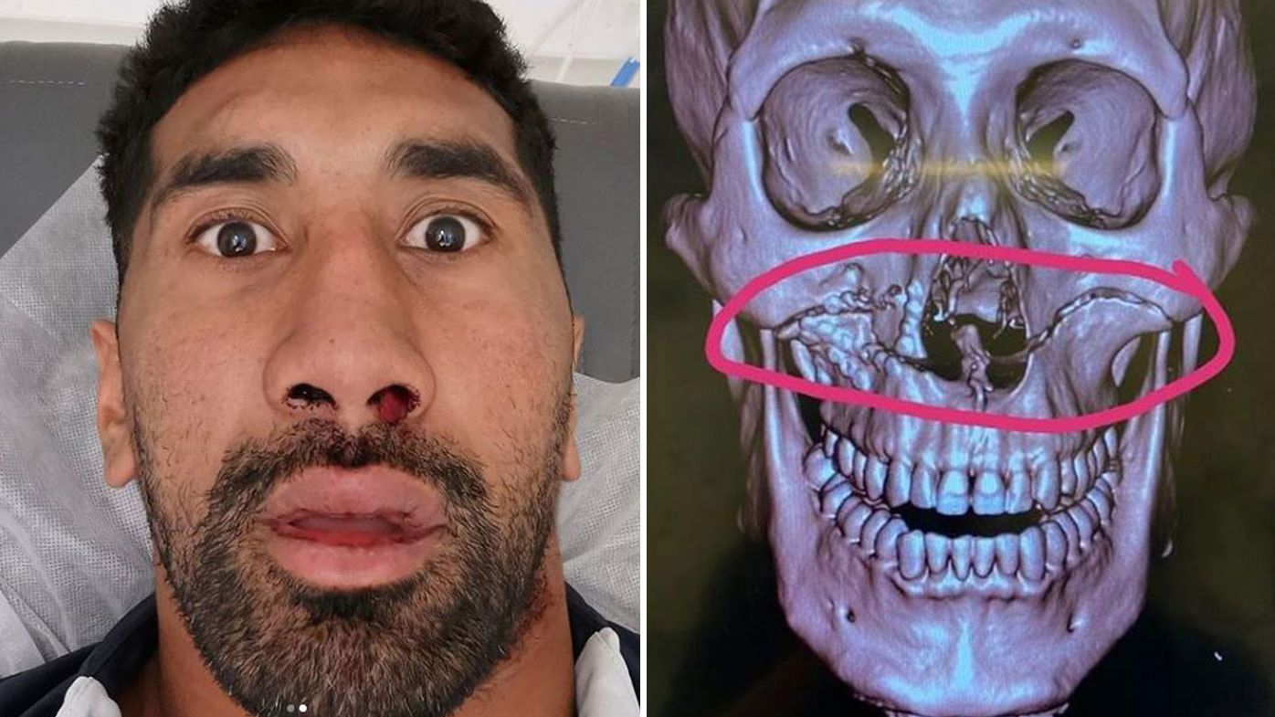 Sia Soliola has revealed the extent of the facial fracture he suffered in a head clash.
