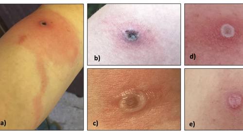 What Alaskapox lesions look like over multiple days and weeks.