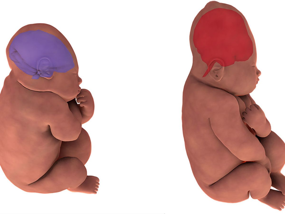 Foetal Head Moulding How A Baby S Skull Changes Shape During Birth 9coach