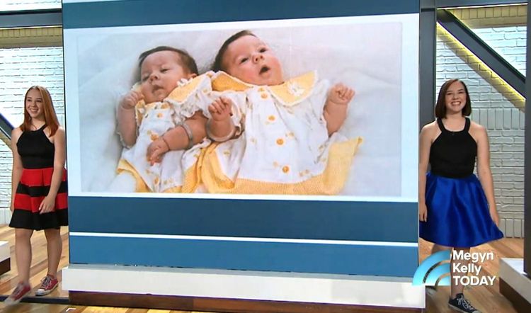 Conjoined twins Sydney and Lexi who survived risky surgery now thriving - 9Honey