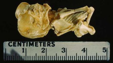 A lithopedian fetus. (Otis Historical Archives of National Museum of Health &amp; Medicine)