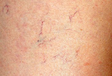 Which of the following procedures is used in the treatment of spider veins?