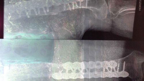X-ray of Christine's broken leg bone after multiple surgeries.