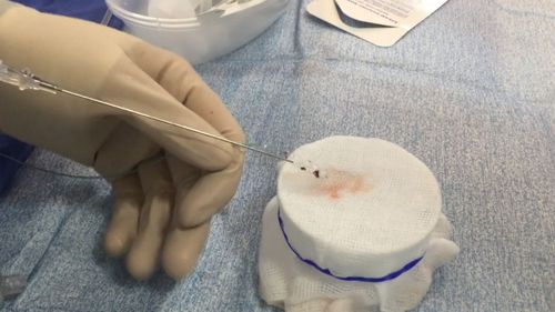 The blood clot is removed from the stroke victim's brain.