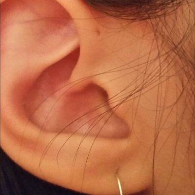 Preauricular pit: Small hole near the ear 