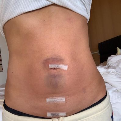 Denise Richards, operation, hernia, scars, hospital, instagram, photos