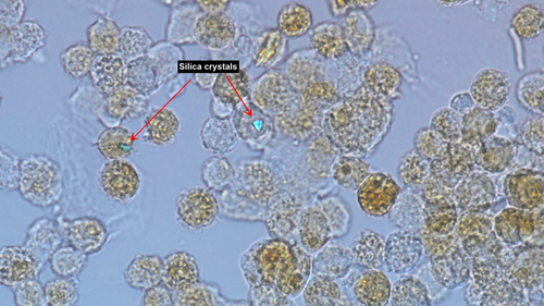 Silica crystals in a patient's lung tissue.