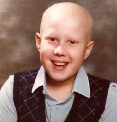 Little Britain star Matt Lucas opens up about battle with alopecia.