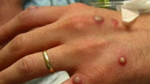 The monkeypox virus is spreading in Melbourne in the first widespread example of local transmission since the global outbreak began.