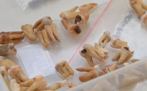 Teeth from the 1900s have been discovered during Metro Tunnel construction work. 