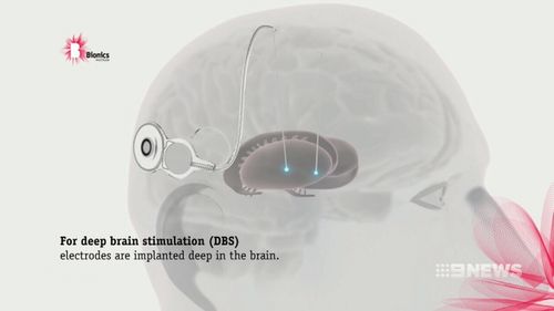 Australian researchers from Melbourne's Bionics Institute have discovered a brain signal that could make treatment for Parkinson's Disease sufferers more accurate and less daunting. Picture: Supplied,