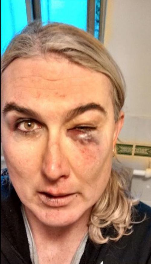 After the attack Ms McCarthy tweeted these photos of her injuries saying she was "attacked for being trans". (Supplied)