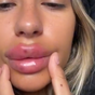 Woman's lip filler treatment goes horribly wrong