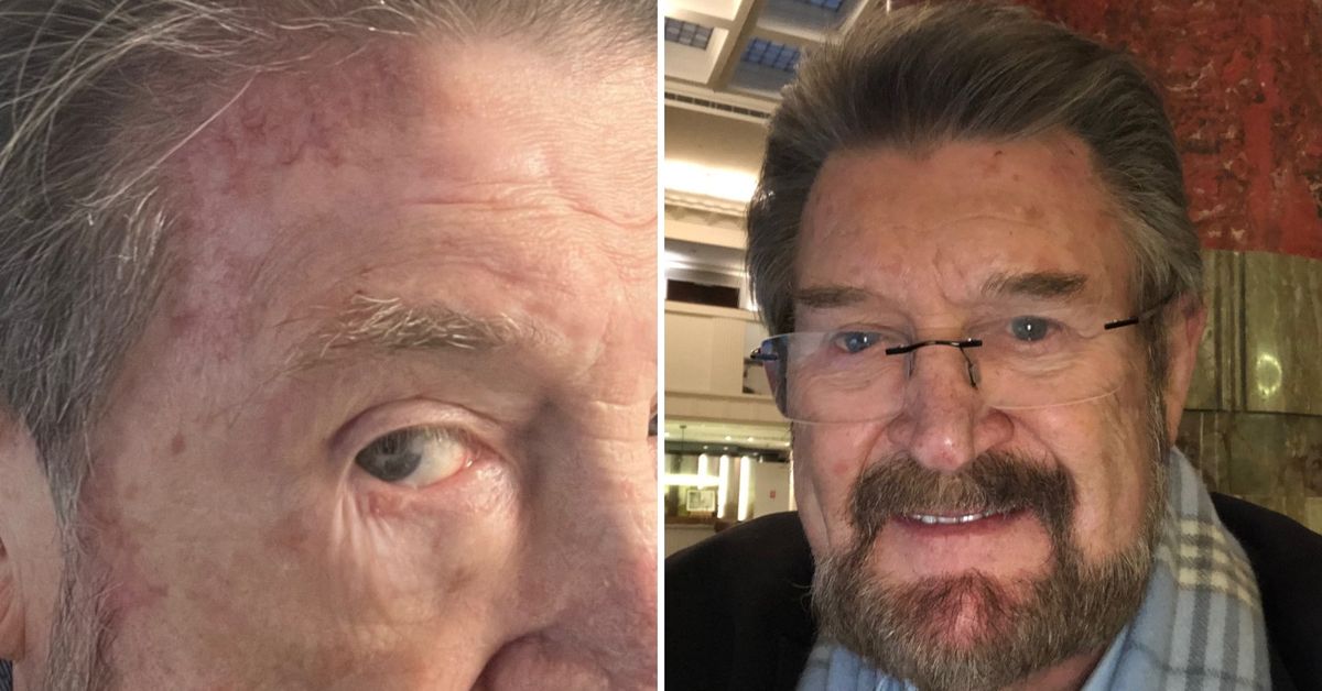 Media personality Derryn Hinch reveals skin cancer battle