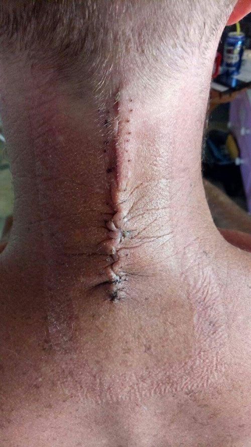 The 43-year-old needed a spinal fusion. (Supplied)