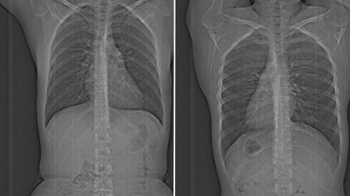 Caitlin Ross has mould growing inside her lungs.