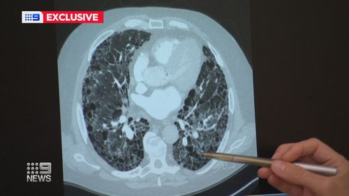Genetic link found among relatives of pulmonary fibrosis sufferers