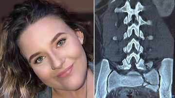 Abbey Sizer suffered serious injuries when the dairy farmer sleepwalked out a second-storey window. 