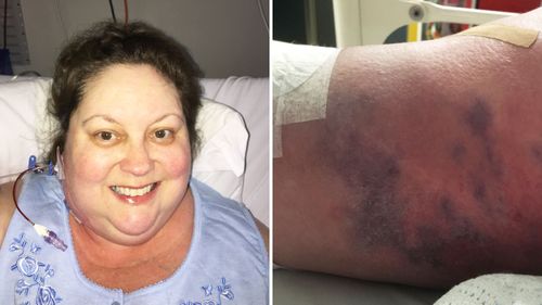 Tiny sores leave Canberra mum fighting for life after developing flesh-eating disease