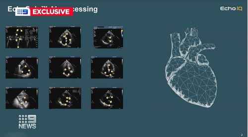 A study has shown artificial intelligence can help doctors decide which patients need surgery for a life-threatening heart condition.