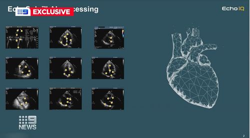 Une étude a montré que l'intelligence artificielle peut aider les médecins à décider quels patients ont besoin d'une intervention chirurgicale pour une maladie cardiaque potentiellement mortelle.