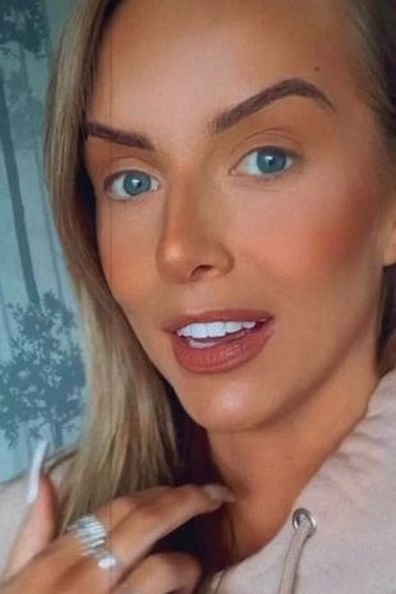 Love Island UK Faye Winter gets filler removed. 