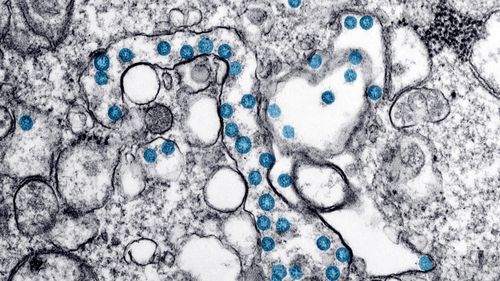 Una imagen de microscopio electrónico muestra las partículas esféricas del nuevo coronavirus, en azul, del primer caso de COVID-19 en EE. UU.