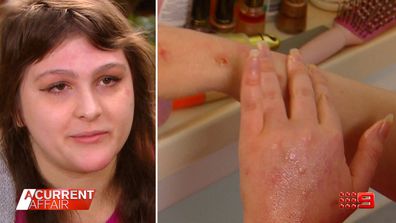 Woman develops painful skin condition through pandemic.