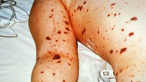 Meningococcal B is now the dominant strain of the disease.