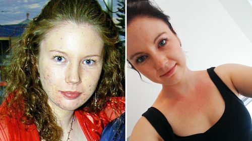 Alexa Finlayson is one of Roaccutane's success stories. She is pictured here as a Perth teenager struggling with acne, and now with clear skin.