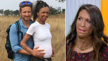 Turia Pitt shares on love, life and pregnancy