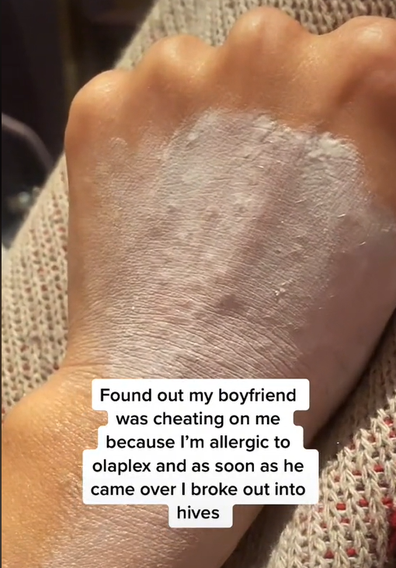 Boyfriend cheating sign rash hives