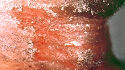 diphtheria skin lesion