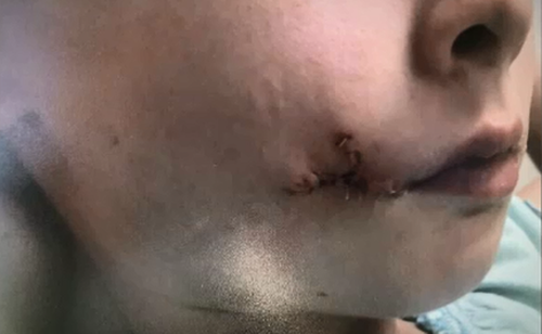 The young girl required stitches on her face after Hank bit her in 2016.