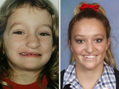 Jess Hosking as a child and teenager after several surgeries for her cleft lip and palate.