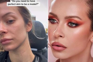 Model shows off her 'real' skin without photoshop