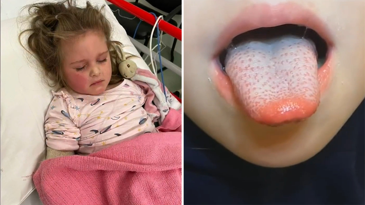 Parents urged to watch for scarlet fever symptoms as strep A cases surge in  Queensland - ABC News