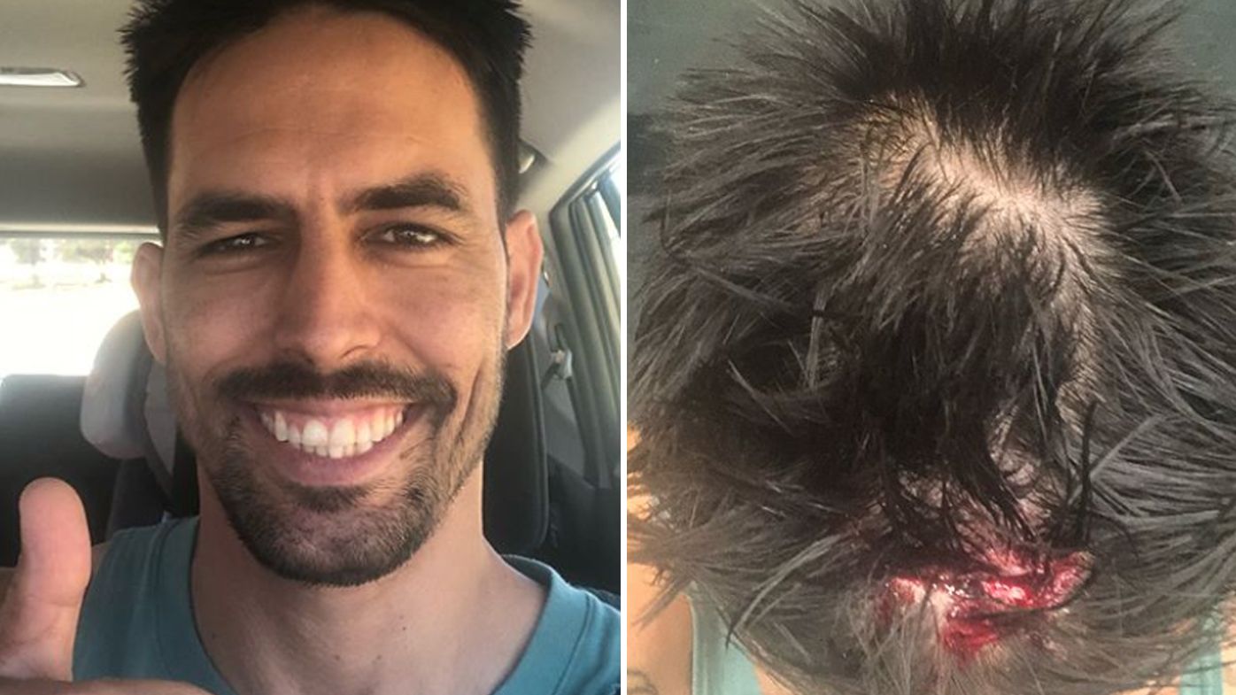 Legendary cricketer Mitchell Johnson receives stitches after nasty head cut